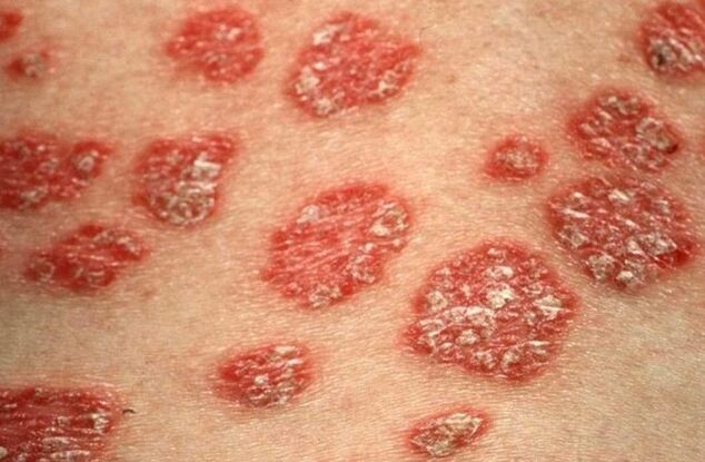 Psoriatik papüller