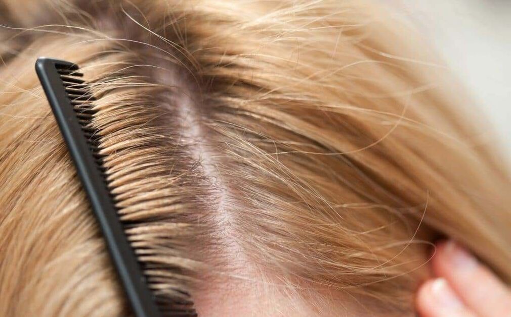 sedef hastalığı türü