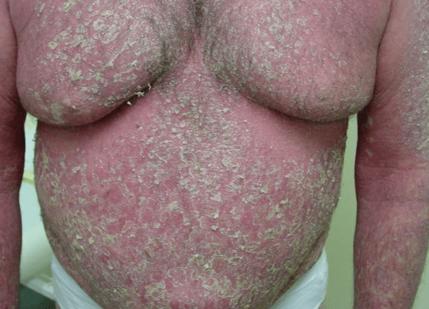 Vücutta psoriatik eritroderma